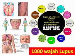 Penyakit Lupus Eritematosus Sistemik